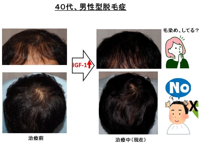 円形脱毛症　病院